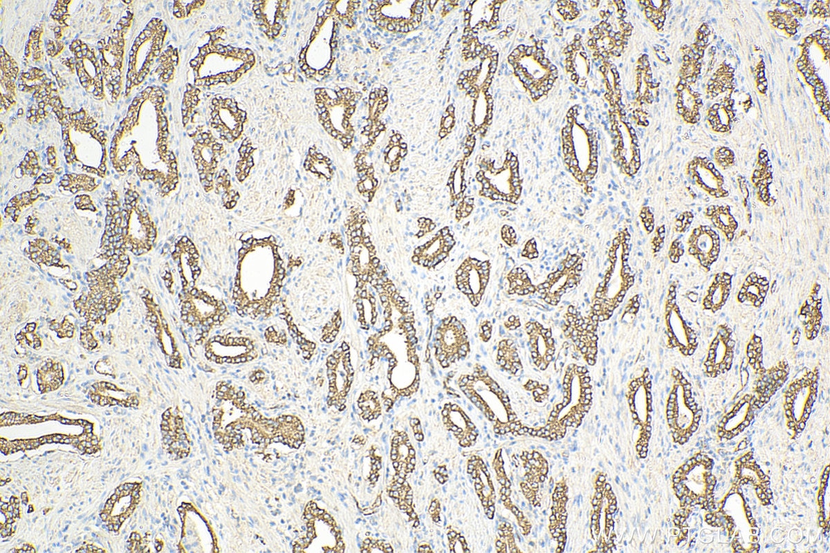 Immunohistochemistry (IHC) staining of human prostate cancer tissue using hD53; TPD52L1 Polyclonal antibody (14732-1-AP)