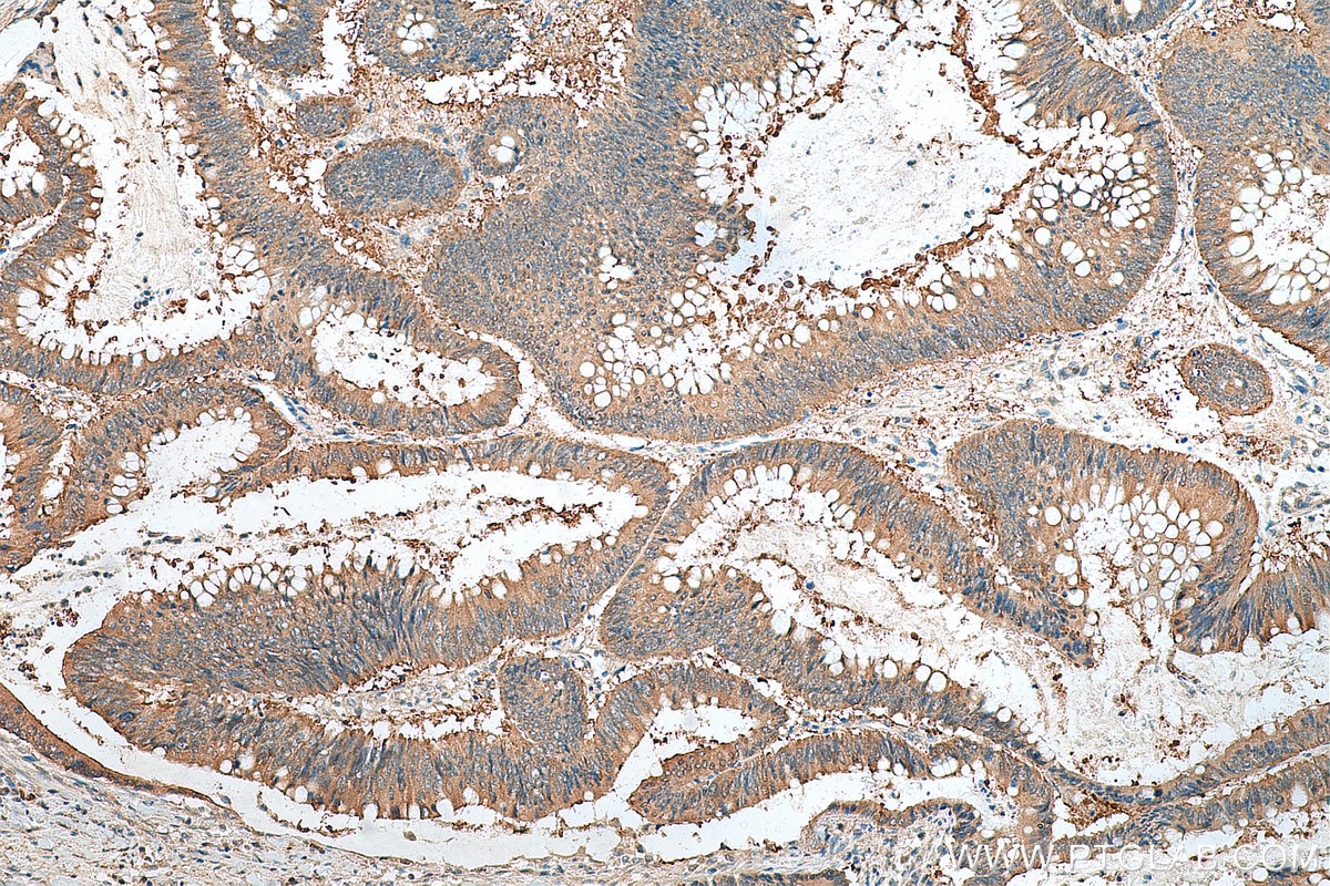 Immunohistochemical analysis of paraffin-embedded human colon cancer tissue slide using 14732-1-AP (hD53; TPD52L1 antibody) at dilution of 1:200 (under 10x lens). Heat mediated antigen retrieval with Tris-EDTA buffer (pH 9.0). Immunohistochemistry (IHC) staining of human colon cancer tissue using hD53; TPD52L1 Polyclonal antibody (14732-1-AP)