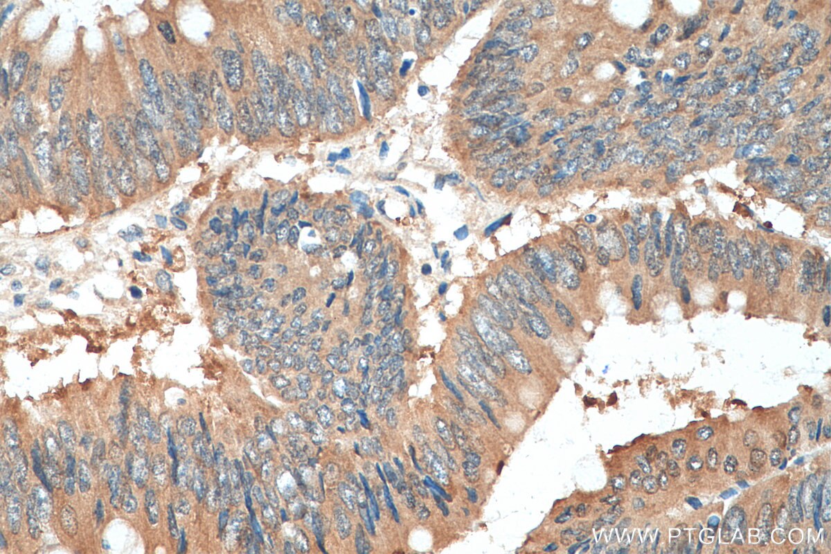 Immunohistochemical analysis of paraffin-embedded human colon cancer tissue slide using 14732-1-AP (hD53; TPD52L1 antibody) at dilution of 1:200 (under 40x lens). Heat mediated antigen retrieval with Tris-EDTA buffer (pH 9.0). Immunohistochemistry (IHC) staining of human colon cancer tissue using hD53; TPD52L1 Polyclonal antibody (14732-1-AP)