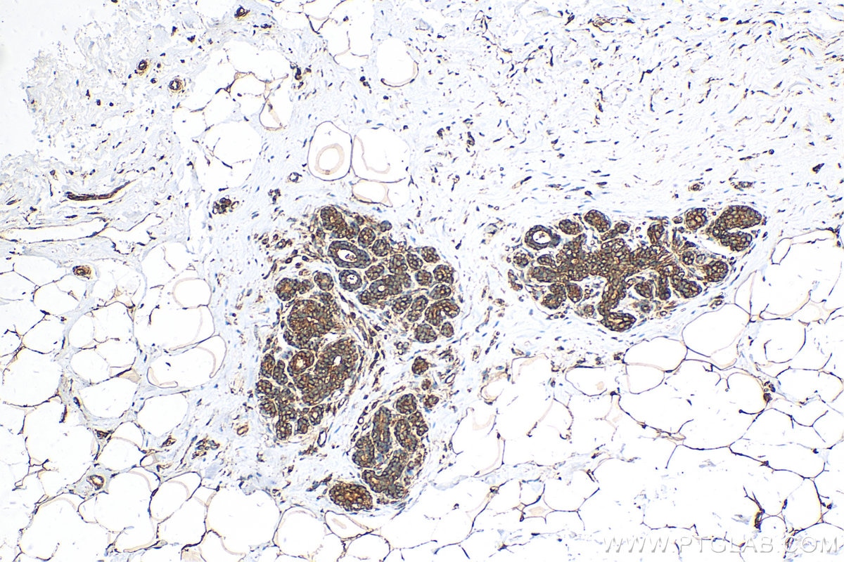 IHC staining of human breast cancer using 11795-1-AP