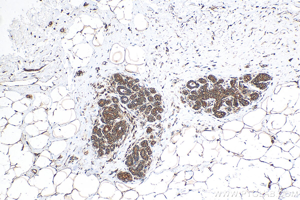 Immunohistochemistry (IHC) staining of human breast cancer tissue using TPD52L2 Polyclonal antibody (11795-1-AP)