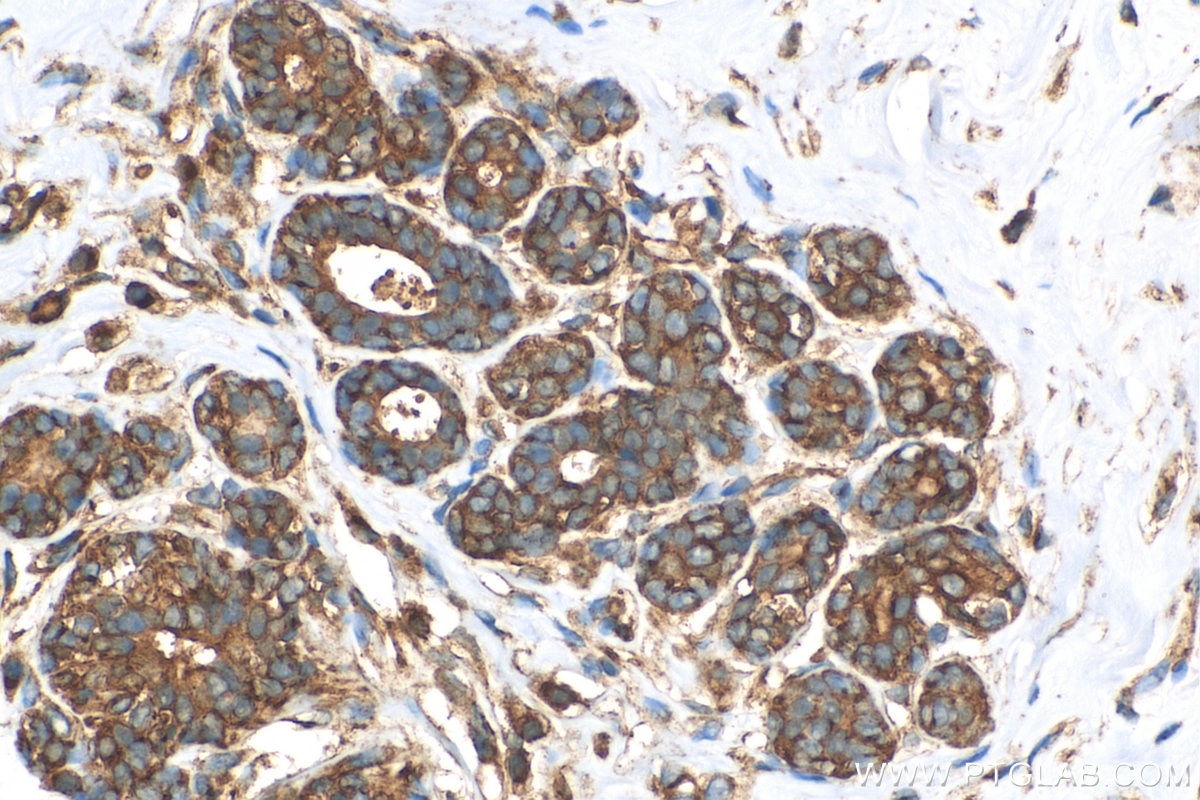 Immunohistochemistry (IHC) staining of human breast cancer tissue using TPD52L2 Polyclonal antibody (11795-1-AP)