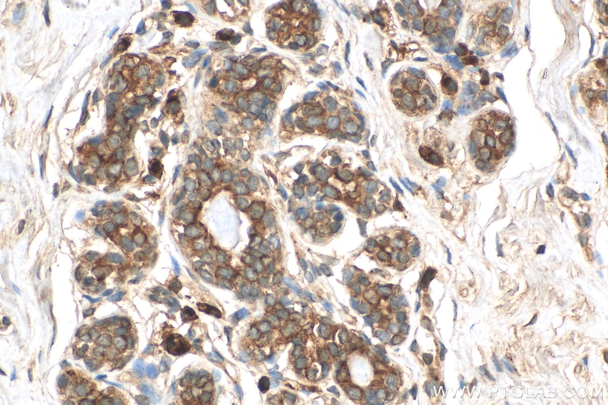 Immunohistochemistry (IHC) staining of human breast cancer tissue using TPD52L2 Monoclonal antibody (68077-1-Ig)