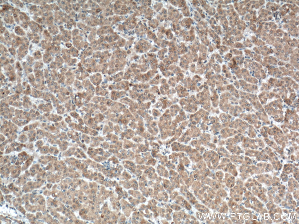 Immunohistochemistry (IHC) staining of human liver cancer tissue using TPH2 Polyclonal antibody (22590-1-AP)