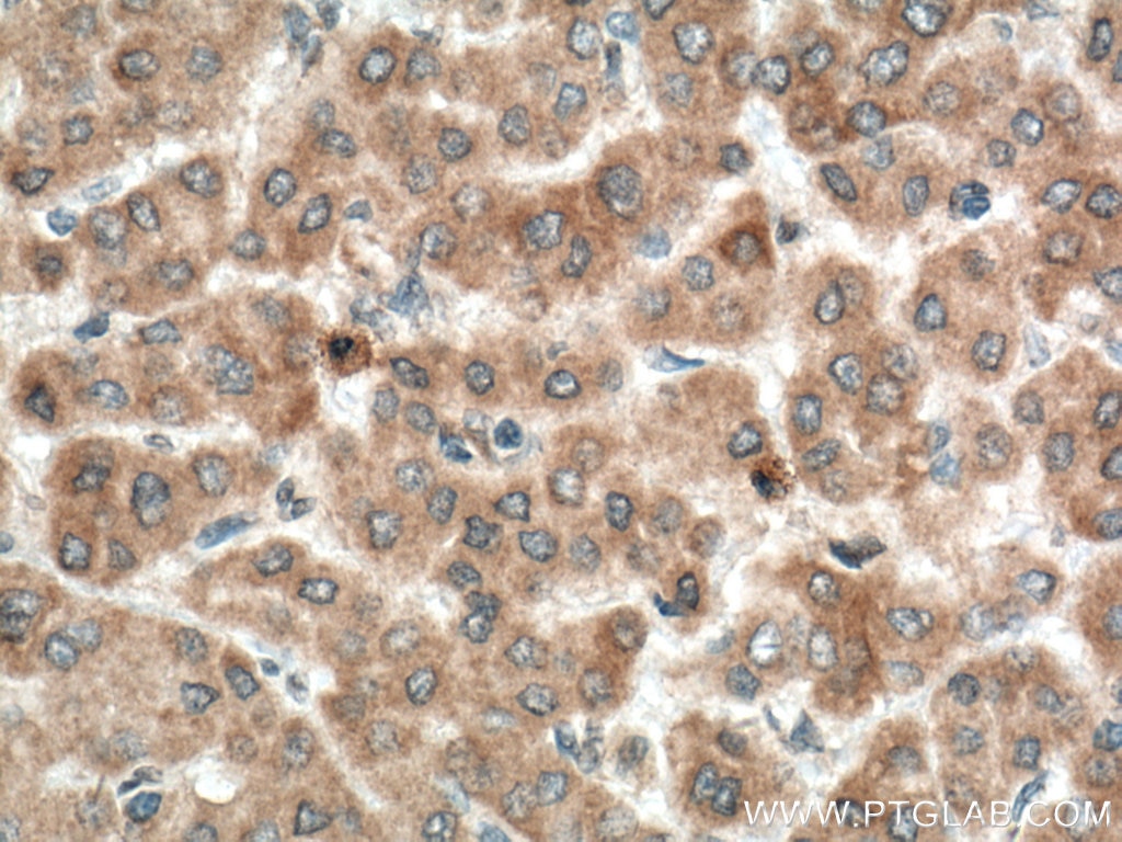 Immunohistochemistry (IHC) staining of human liver cancer tissue using TPH2 Polyclonal antibody (22590-1-AP)