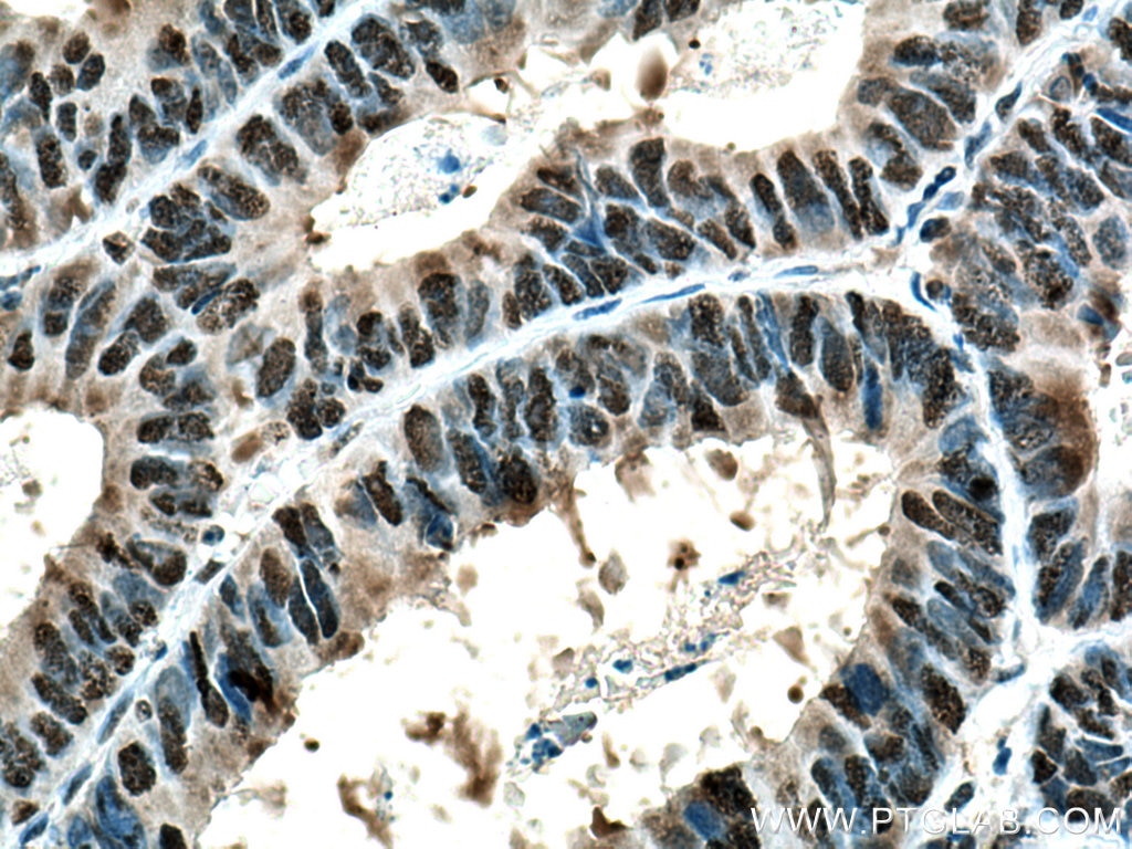 IHC staining of human colon cancer using 10713-1-AP