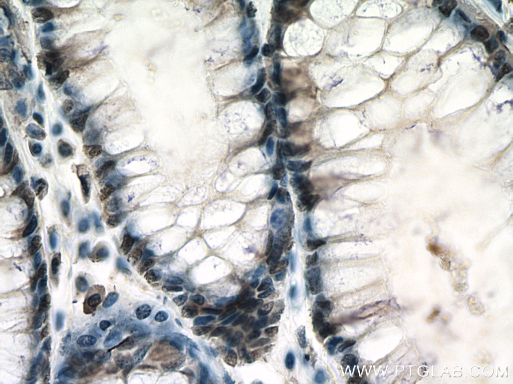 Immunohistochemistry (IHC) staining of human colon cancer tissue using TPI1 Monoclonal antibody (67515-1-Ig)