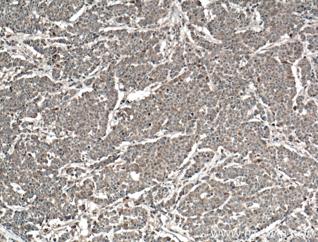 Immunohistochemistry (IHC) staining of human colon cancer tissue using TPK1 Polyclonal antibody (10942-1-AP)