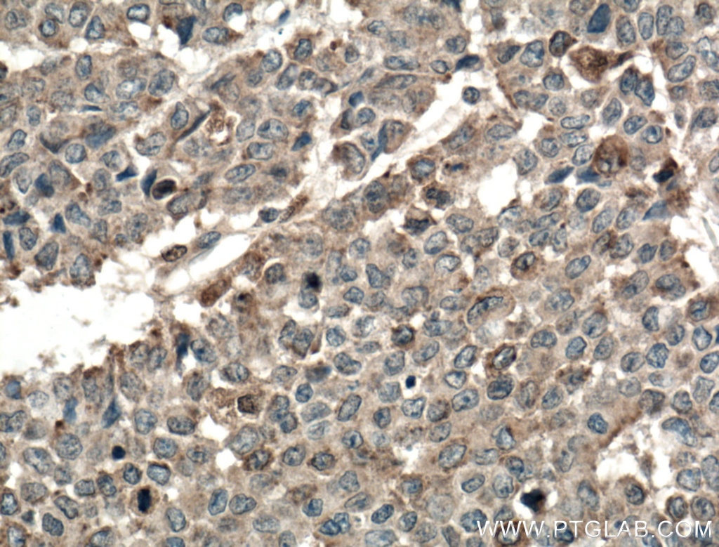 Immunohistochemistry (IHC) staining of human colon cancer tissue using TPK1 Polyclonal antibody (10942-1-AP)