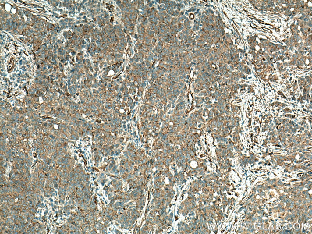 IHC staining of human stomach cancer using 28477-1-AP