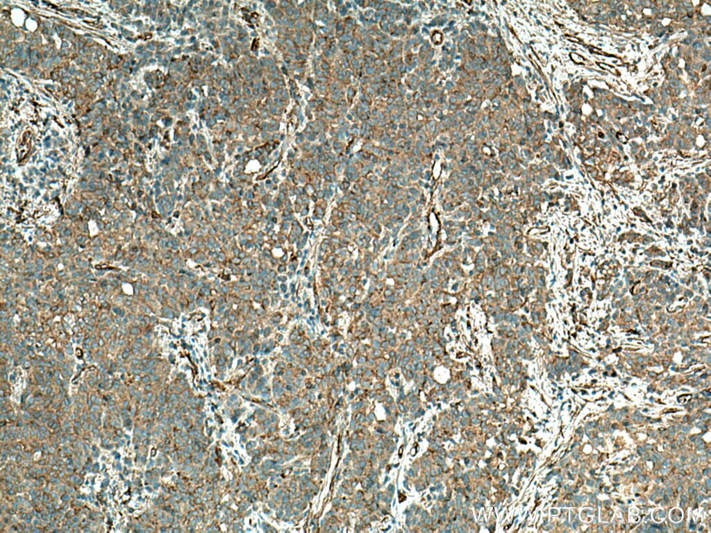 Immunohistochemistry (IHC) staining of human stomach cancer tissue using TPM1 Polyclonal antibody (28477-1-AP)