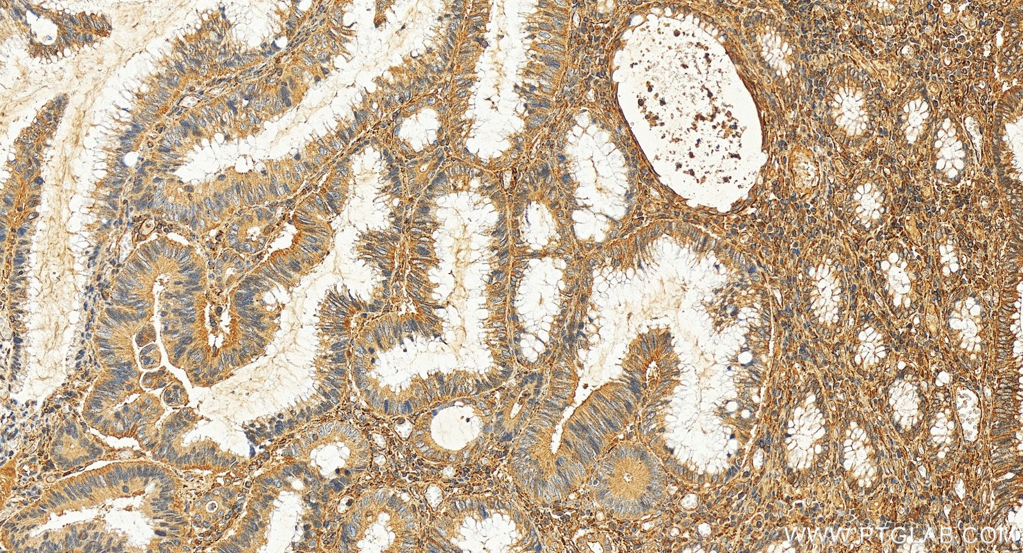 Immunohistochemistry (IHC) staining of human colon cancer tissue using TPM3 Polyclonal antibody (10737-1-AP)