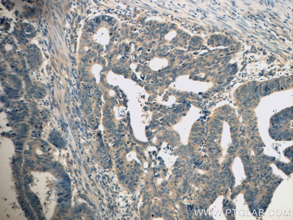 Immunohistochemistry (IHC) staining of human colon cancer tissue using TPM3 Polyclonal antibody (10737-1-AP)