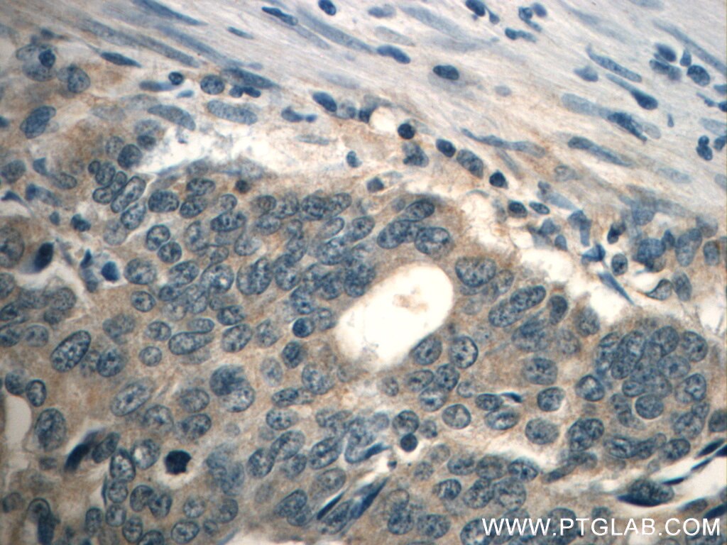 Immunohistochemistry (IHC) staining of human colon cancer tissue using TPM3 Polyclonal antibody (10737-1-AP)