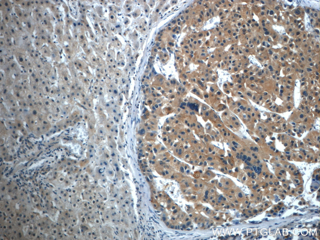 Immunohistochemistry (IHC) staining of human liver cancer tissue using TPM3 Polyclonal antibody (10737-1-AP)