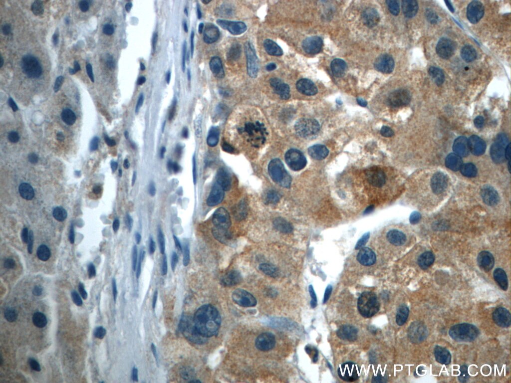 Immunohistochemistry (IHC) staining of human liver cancer tissue using TPM3 Polyclonal antibody (10737-1-AP)