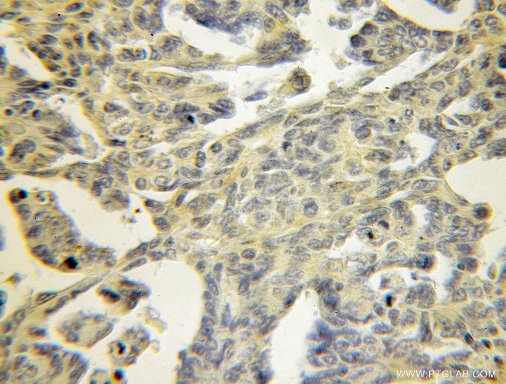 Immunohistochemistry (IHC) staining of human ovary tumor tissue using TPM3 Polyclonal antibody (10737-1-AP)
