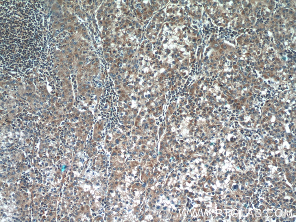 Immunohistochemistry (IHC) staining of human liver cancer tissue using TPM3 Polyclonal antibody (55444-1-AP)