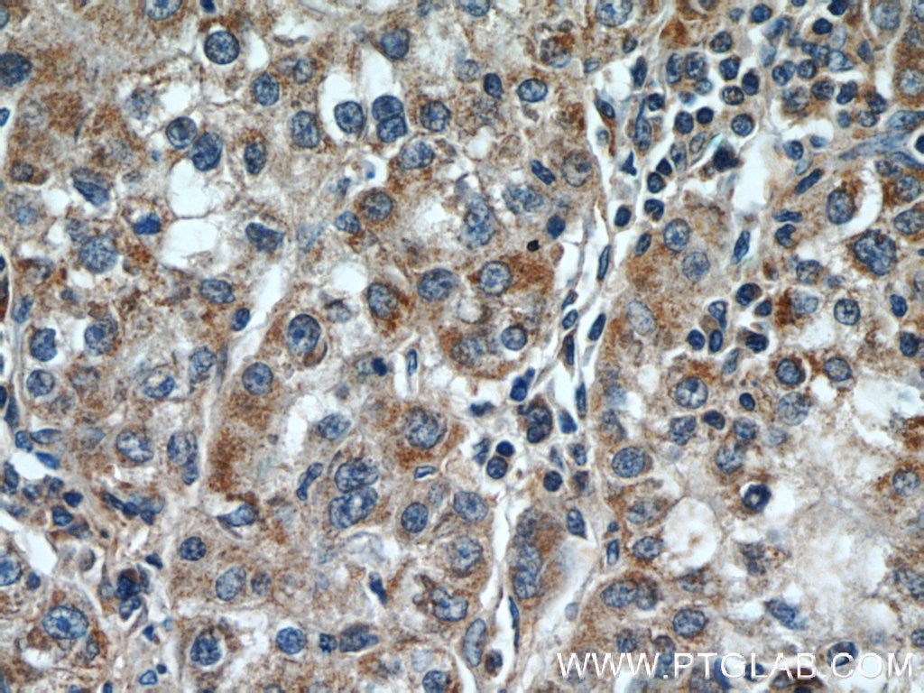 Immunohistochemistry (IHC) staining of human liver cancer tissue using TPM3 Polyclonal antibody (55444-1-AP)