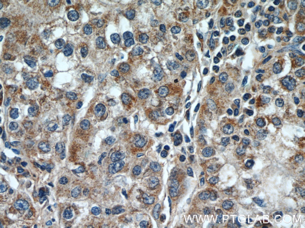 IHC staining of human liver cancer using 55444-1-AP