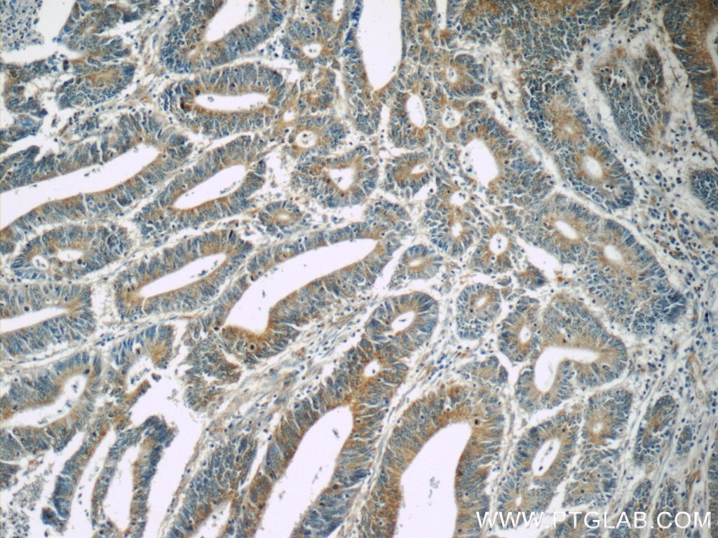 Immunohistochemistry (IHC) staining of human colon cancer tissue using TPM3 Polyclonal antibody (55444-1-AP)