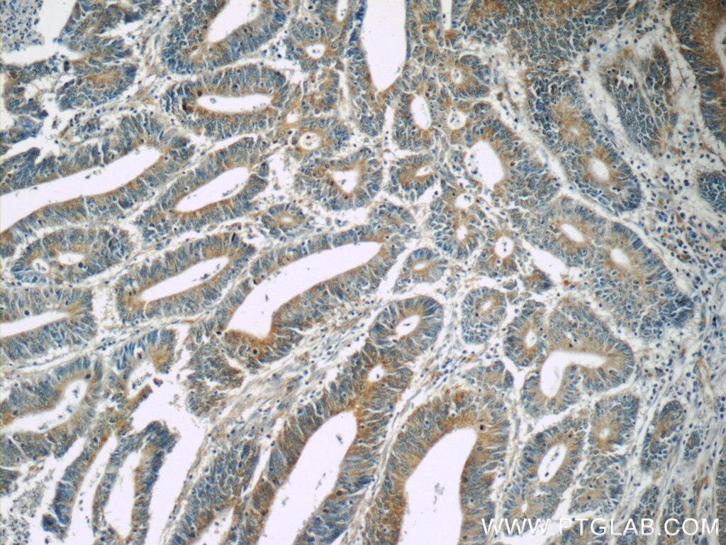 IHC staining of human colon cancer using 55444-1-AP