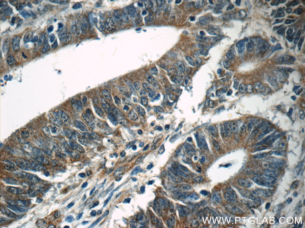 Immunohistochemistry (IHC) staining of human colon cancer tissue using TPM3 Polyclonal antibody (55444-1-AP)