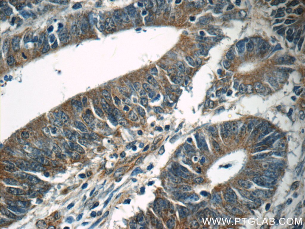 IHC staining of human colon cancer using 55444-1-AP