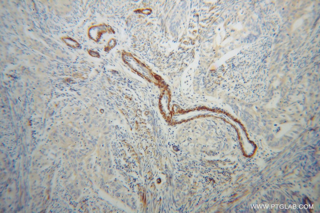 IHC staining of human endometrial cancer using 13741-1-AP