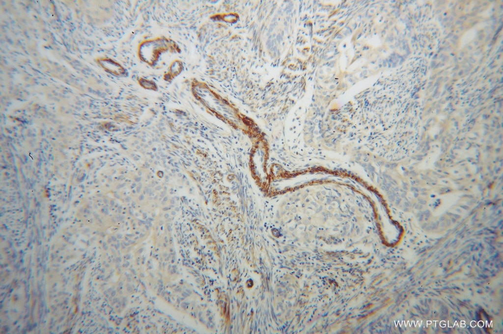 Immunohistochemistry (IHC) staining of human endometrial cancer tissue using TPM4 Polyclonal antibody (13741-1-AP)