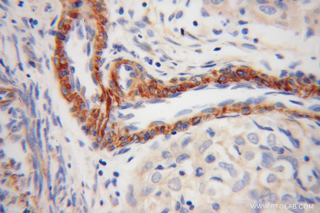 Immunohistochemistry (IHC) staining of human endometrial cancer tissue using TPM4 Polyclonal antibody (13741-1-AP)