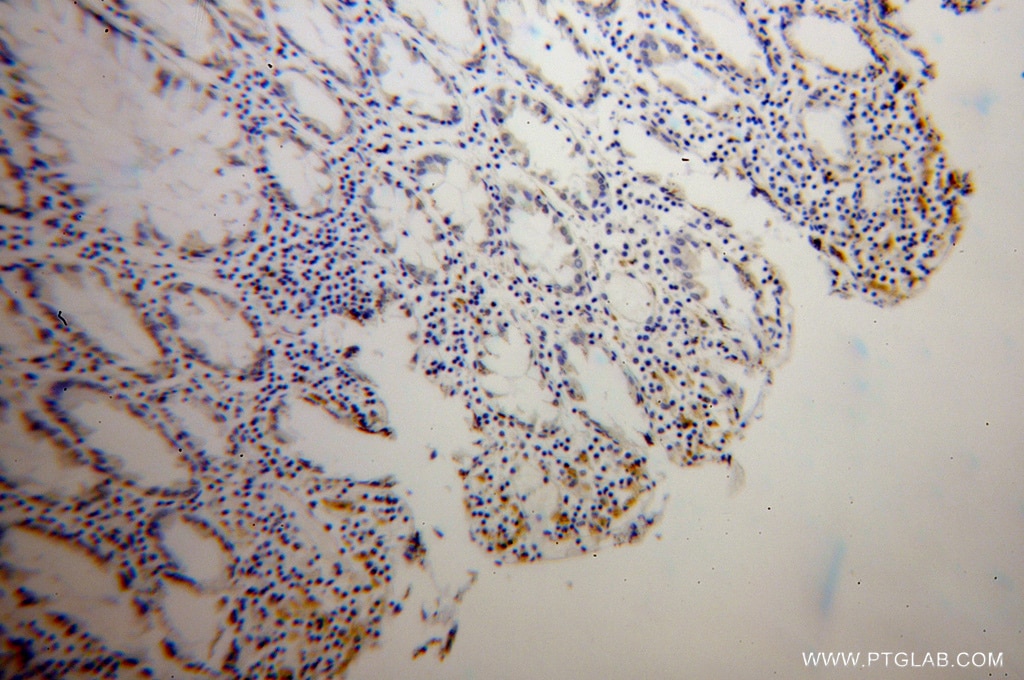 IHC staining of human colon cancer using 12479-1-AP
