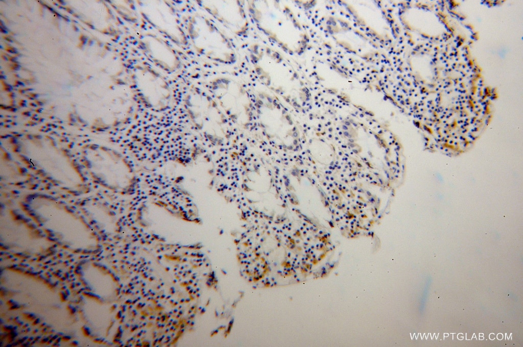 Immunohistochemistry (IHC) staining of human colon cancer tissue using TPP1 Polyclonal antibody (12479-1-AP)