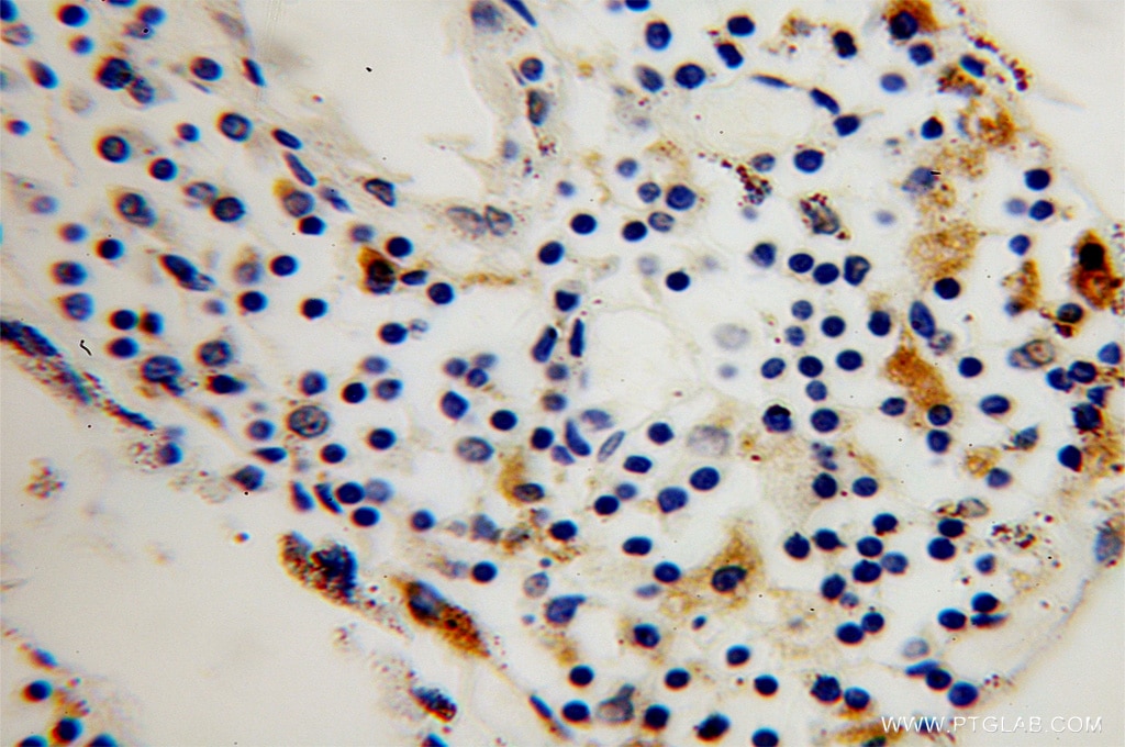 Immunohistochemistry (IHC) staining of human colon cancer tissue using TPP1 Polyclonal antibody (12479-1-AP)