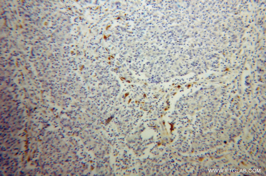 Immunohistochemistry (IHC) staining of human colon cancer tissue using TPP1 Polyclonal antibody (12479-1-AP)