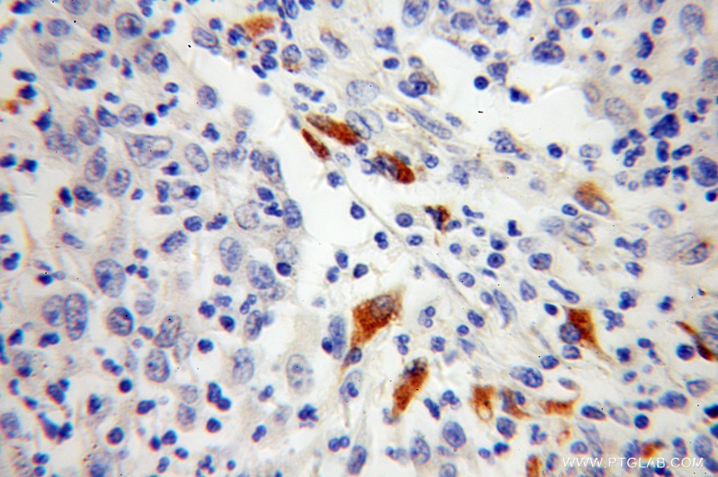 Immunohistochemistry (IHC) staining of human colon cancer tissue using TPP1 Polyclonal antibody (12479-1-AP)
