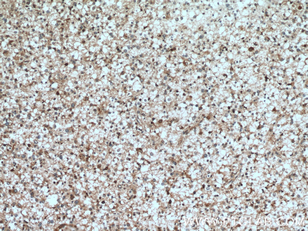 Immunohistochemistry (IHC) staining of human gliomas tissue using TPPII Polyclonal antibody (14120-1-AP)