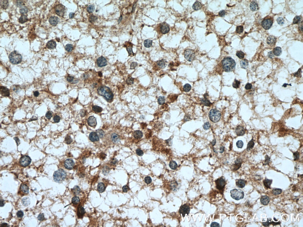 Immunohistochemistry (IHC) staining of human gliomas tissue using TPPII Polyclonal antibody (14120-1-AP)
