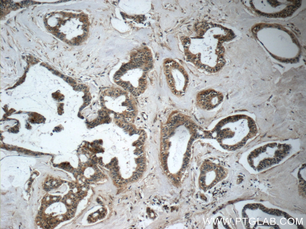Immunohistochemistry (IHC) staining of human breast cancer tissue using TPPP Polyclonal antibody (25040-1-AP)