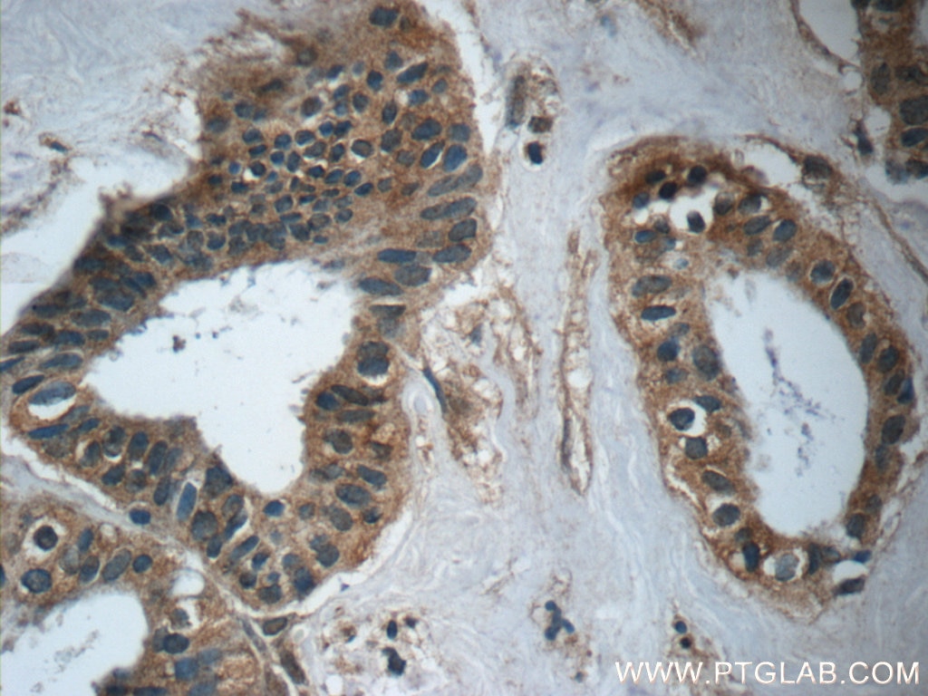 Immunohistochemistry (IHC) staining of human breast cancer tissue using TPPP Polyclonal antibody (25040-1-AP)
