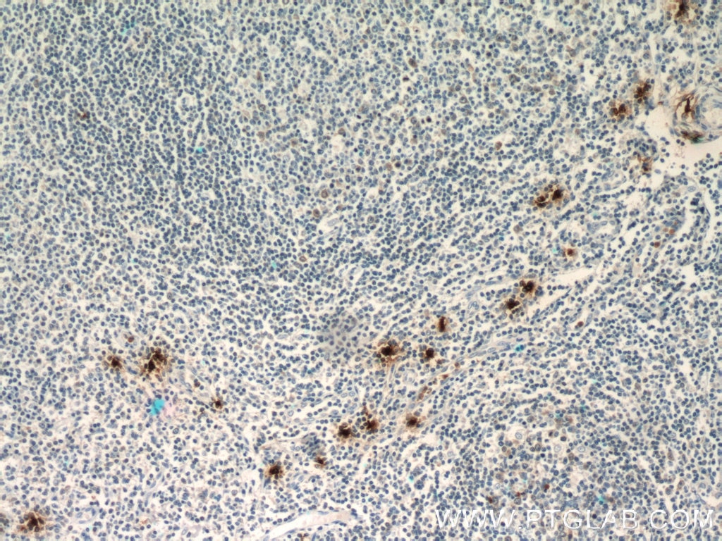 Immunohistochemistry (IHC) staining of human tonsillitis tissue using TPSAB1 Polyclonal antibody (13343-1-AP)