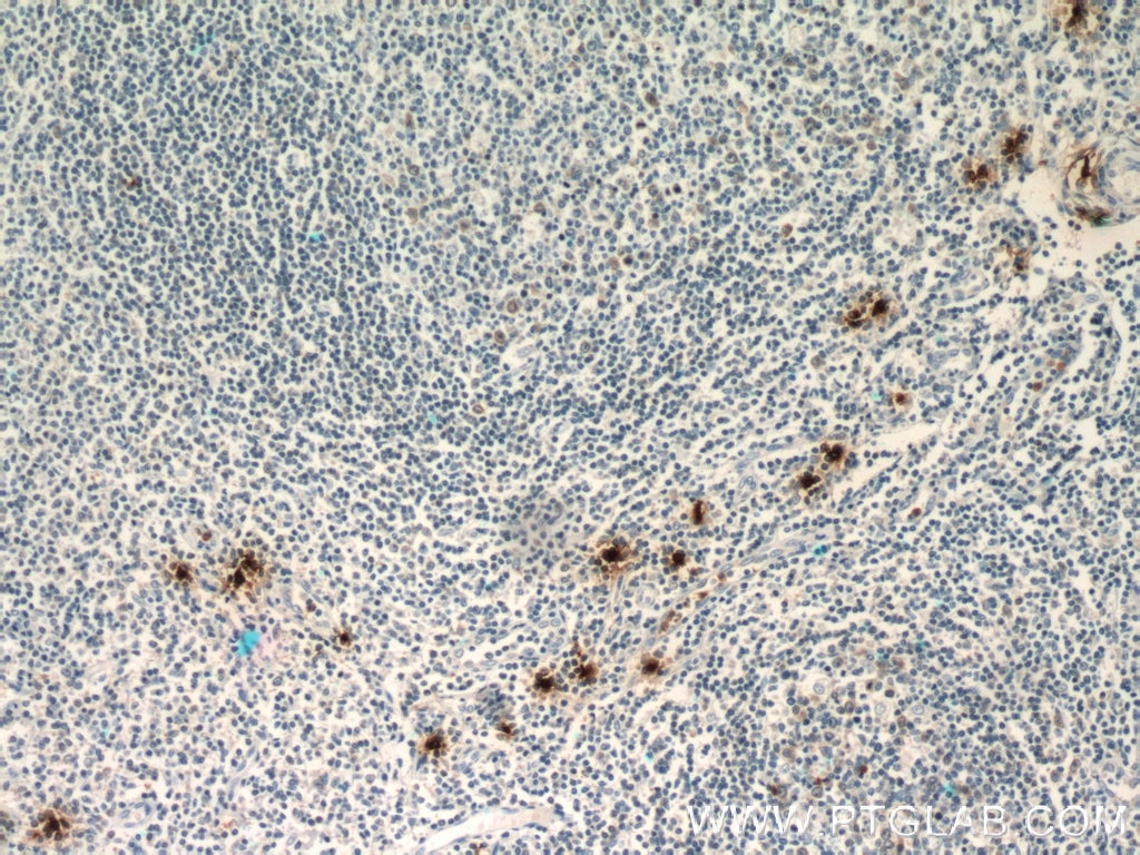 IHC staining of human tonsillitis using 13343-1-AP