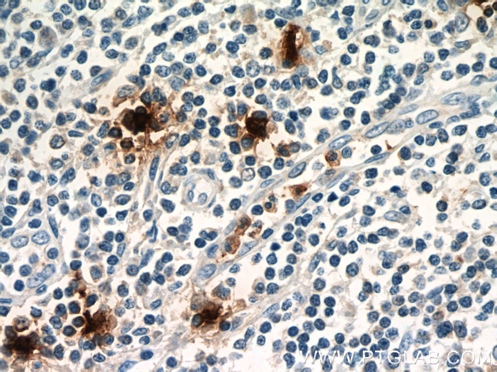 Immunohistochemistry (IHC) staining of human tonsillitis tissue using TPSAB1 Polyclonal antibody (13343-1-AP)