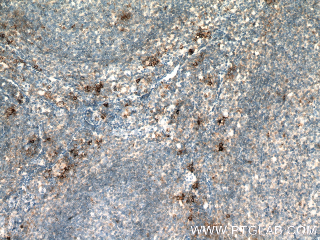 Immunohistochemistry (IHC) staining of human tonsillitis tissue using TPSAB1 Polyclonal antibody (13343-1-AP)