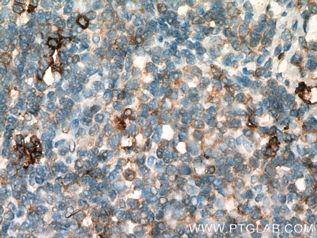 Immunohistochemistry (IHC) staining of human tonsillitis tissue using TPSAB1 Polyclonal antibody (13343-1-AP)