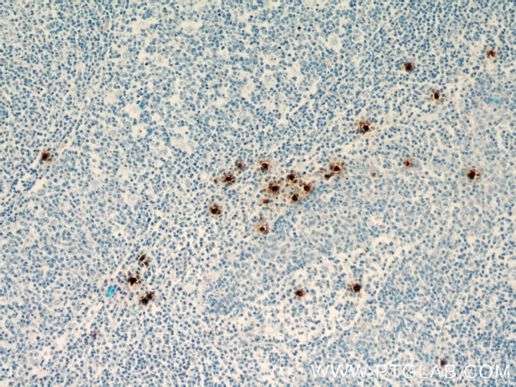 Immunohistochemistry (IHC) staining of human tonsillitis tissue using TPSAB1 Monoclonal antibody (66174-1-Ig)