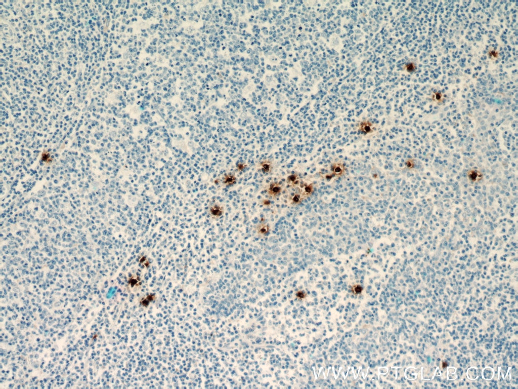 IHC staining of human tonsillitis using 66174-1-Ig