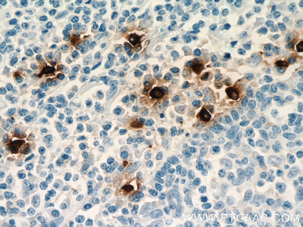 Immunohistochemistry (IHC) staining of human tonsillitis tissue using TPSAB1 Monoclonal antibody (66174-1-Ig)