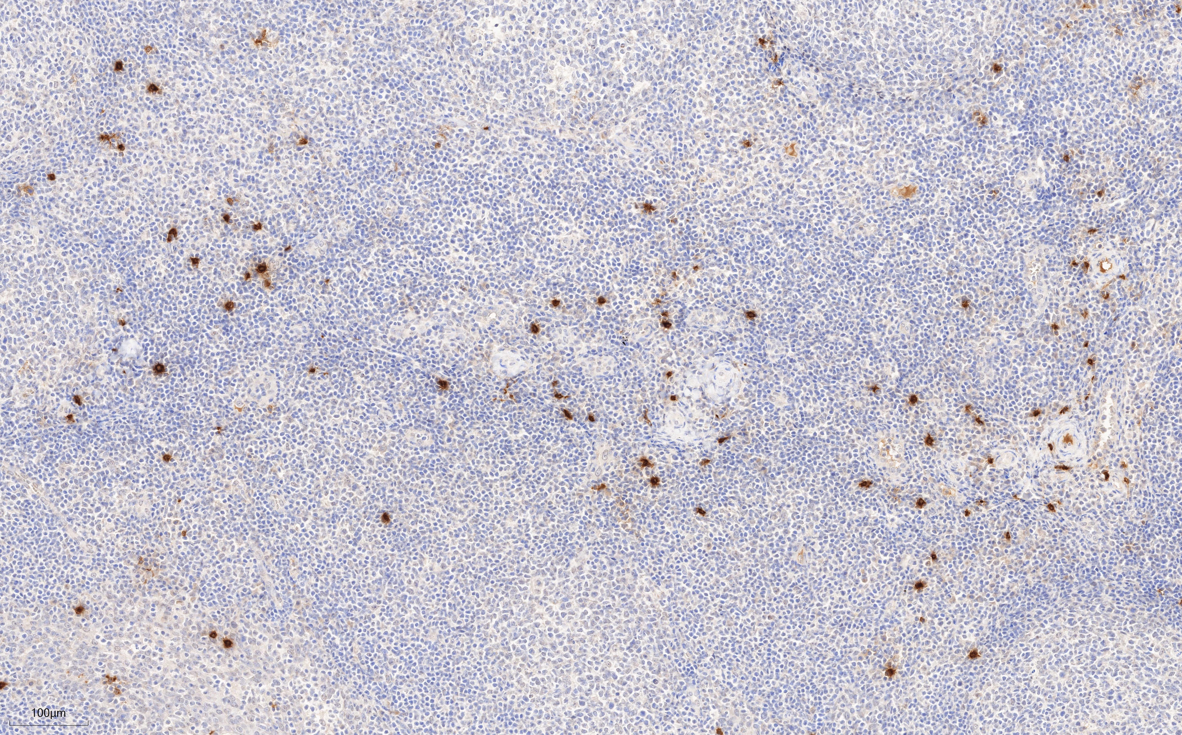 Immunohistochemistry (IHC) staining of human tonsillitis tissue using TPSAB1 Monoclonal antibody (66174-1-Ig)