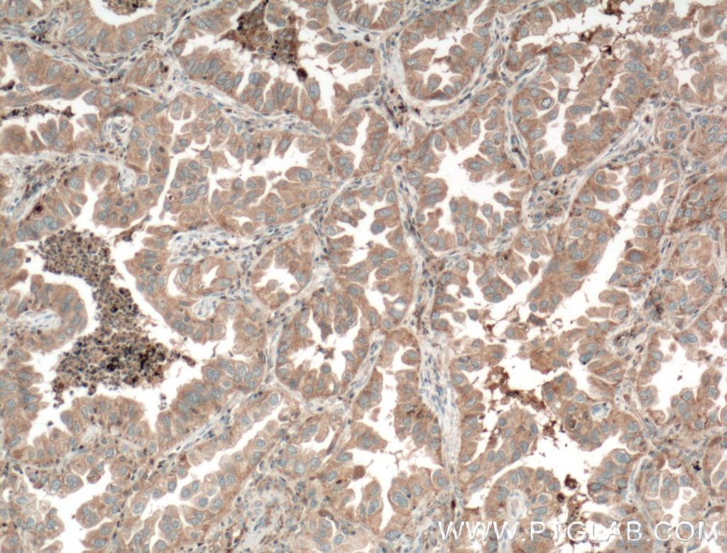 Immunohistochemistry (IHC) staining of human lung cancer tissue using TPSD1 Polyclonal antibody (55239-1-AP)